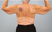 Arm Lift Before Photo by Keith Neaman, MD; Salem, OR - Case 50768