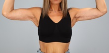 Arm Lift After Photo by Keith Neaman, MD; Salem, OR - Case 50824