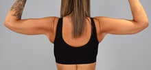 Arm Lift After Photo by Keith Neaman, MD; Salem, OR - Case 50824