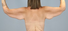 Arm Lift Before Photo by Keith Neaman, MD; Salem, OR - Case 50824