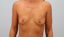 Breast Augmentation Before Photo by Keith Neaman, MD; Salem, OR - Case 50841