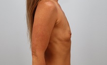 Breast Augmentation Before Photo by Keith Neaman, MD; Salem, OR - Case 50841