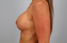 Breast Augmentation After Photo by Keith Neaman, MD; Salem, OR - Case 50841