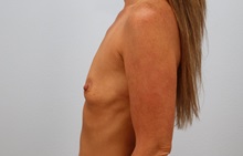 Breast Augmentation Before Photo by Keith Neaman, MD; Salem, OR - Case 50841