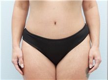 Tummy Tuck After Photo by Keith Neaman, MD; Salem, OR - Case 49909 Tummy Tuck After Photo by Keith Neaman, MD; Salem, OR - Case 49909