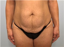 Tummy Tuck Before Photo by Keith Neaman, MD; Salem, OR - Case 49909 Tummy Tuck Before Photo by Keith Neaman, MD; Salem, OR - Case 49909
