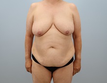 Mommy Makeover Before Photo by Keith Neaman, MD; Salem, OR - Case 49910