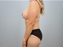 Mommy Makeover After Photo by Keith Neaman, MD; Salem, OR - Case 49913