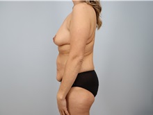 Mommy Makeover Before Photo by Keith Neaman, MD; Salem, OR - Case 49913