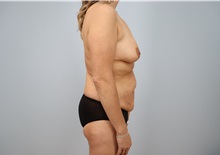 Mommy Makeover Before Photo by Keith Neaman, MD; Salem, OR - Case 49913