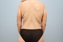 Mommy Makeover After Photo by Keith Neaman, MD; Salem, OR - Case 49913