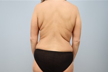 Mommy Makeover Before Photo by Keith Neaman, MD; Salem, OR - Case 49913
