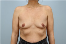 Breast Augmentation Before Photo by Keith Neaman, MD; Salem, OR - Case 49914 Breast Augmentation Before Photo by Keith Neaman, MD; Salem, OR - Case 49914