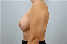 Breast Augmentation After Photo by Keith Neaman, MD; Salem, OR - Case 49914