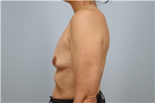 Breast Augmentation Before Photo by Keith Neaman, MD; Salem, OR - Case 49914