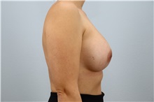 Breast Augmentation After Photo by Keith Neaman, MD; Salem, OR - Case 49914