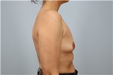 Breast Augmentation Before Photo by Keith Neaman, MD; Salem, OR - Case 49914