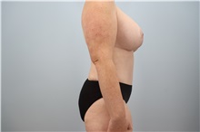 Mommy Makeover After Photo by Keith Neaman, MD; Salem, OR - Case 49948