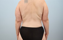 Mommy Makeover After Photo by Keith Neaman, MD; Salem, OR - Case 49948