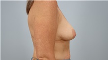 Breast Lift Before Photo by Keith Neaman, MD; Salem, OR - Case 49992