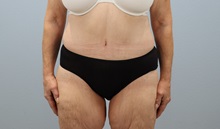 Tummy Tuck After Photo by Keith Neaman, MD; Salem, OR - Case 49991 Tummy Tuck After Photo by Keith Neaman, MD; Salem, OR - Case 49991