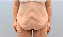 Tummy Tuck Before Photo by Keith Neaman, MD; Salem, OR - Case 49991 Tummy Tuck Before Photo by Keith Neaman, MD; Salem, OR - Case 49991