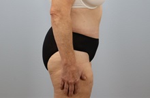 Tummy Tuck After Photo by Keith Neaman, MD; Salem, OR - Case 49991