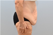 Tummy Tuck Before Photo by Keith Neaman, MD; Salem, OR - Case 49991