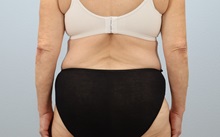 Tummy Tuck After Photo by Keith Neaman, MD; Salem, OR - Case 49991