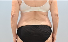 Tummy Tuck Before Photo by Keith Neaman, MD; Salem, OR - Case 49991