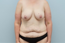 Mommy Makeover Before Photo by Keith Neaman, MD; Salem, OR - Case 49999 Mommy Makeover Before Photo by Keith Neaman, MD; Salem, OR - Case 49999
