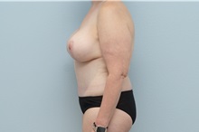 Mommy Makeover After Photo by Keith Neaman, MD; Salem, OR - Case 49999