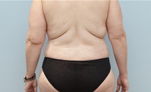 Mommy Makeover After Photo by Keith Neaman, MD; Salem, OR - Case 49999
