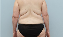Mommy Makeover Before Photo by Keith Neaman, MD; Salem, OR - Case 49999