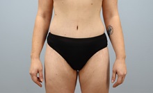 Tummy Tuck After Photo by Keith Neaman, MD; Salem, OR - Case 50050 Tummy Tuck After Photo by Keith Neaman, MD; Salem, OR - Case 50050
