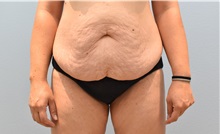 Tummy Tuck Before Photo by Keith Neaman, MD; Salem, OR - Case 50050 Tummy Tuck Before Photo by Keith Neaman, MD; Salem, OR - Case 50050