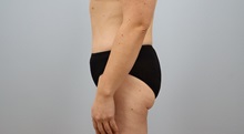 Tummy Tuck After Photo by Keith Neaman, MD; Salem, OR - Case 50050