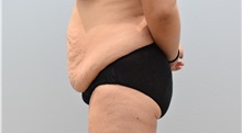 Tummy Tuck Before Photo by Keith Neaman, MD; Salem, OR - Case 50050