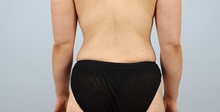 Tummy Tuck After Photo by Keith Neaman, MD; Salem, OR - Case 50050