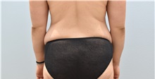Tummy Tuck Before Photo by Keith Neaman, MD; Salem, OR - Case 50050
