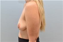 Breast Lift Before Photo by Keith Neaman, MD; Salem, OR - Case 50049