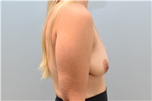 Breast Lift Before Photo by Keith Neaman, MD; Salem, OR - Case 50049