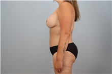 Mommy Makeover After Photo by Keith Neaman, MD; Salem, OR - Case 50051