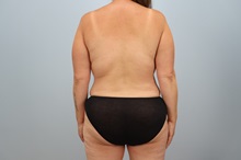 Mommy Makeover After Photo by Keith Neaman, MD; Salem, OR - Case 50051