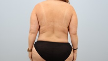 Mommy Makeover After Photo by Keith Neaman, MD; Salem, OR - Case 50080