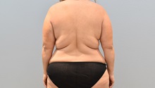 Mommy Makeover Before Photo by Keith Neaman, MD; Salem, OR - Case 50080
