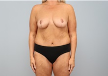 Mommy Makeover After Photo by Keith Neaman, MD; ,  - Case 50211