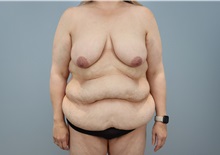 Mommy Makeover Before Photo by Keith Neaman, MD; ,  - Case 50211