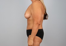 Mommy Makeover After Photo by Keith Neaman, MD; ,  - Case 50211