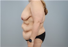 Mommy Makeover Before Photo by Keith Neaman, MD; ,  - Case 50211